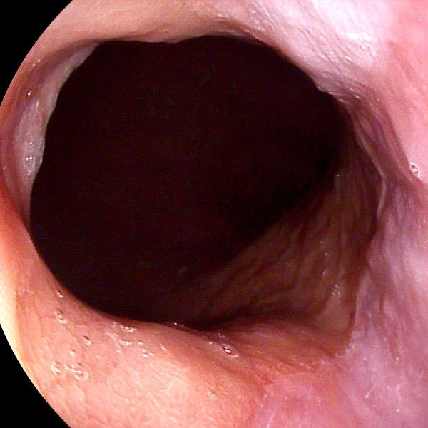 Cardias sin hernia hiatal