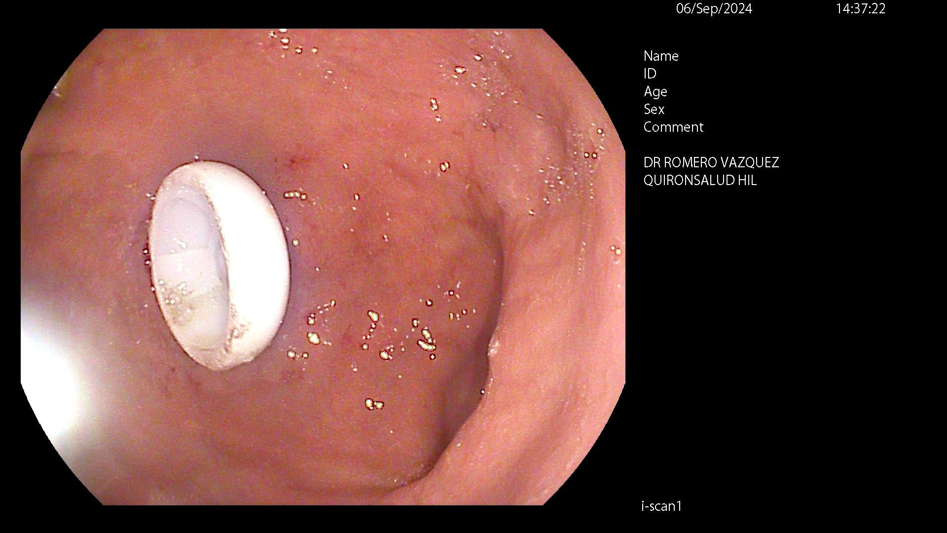 Colocación de sonda PEG - Paso 3