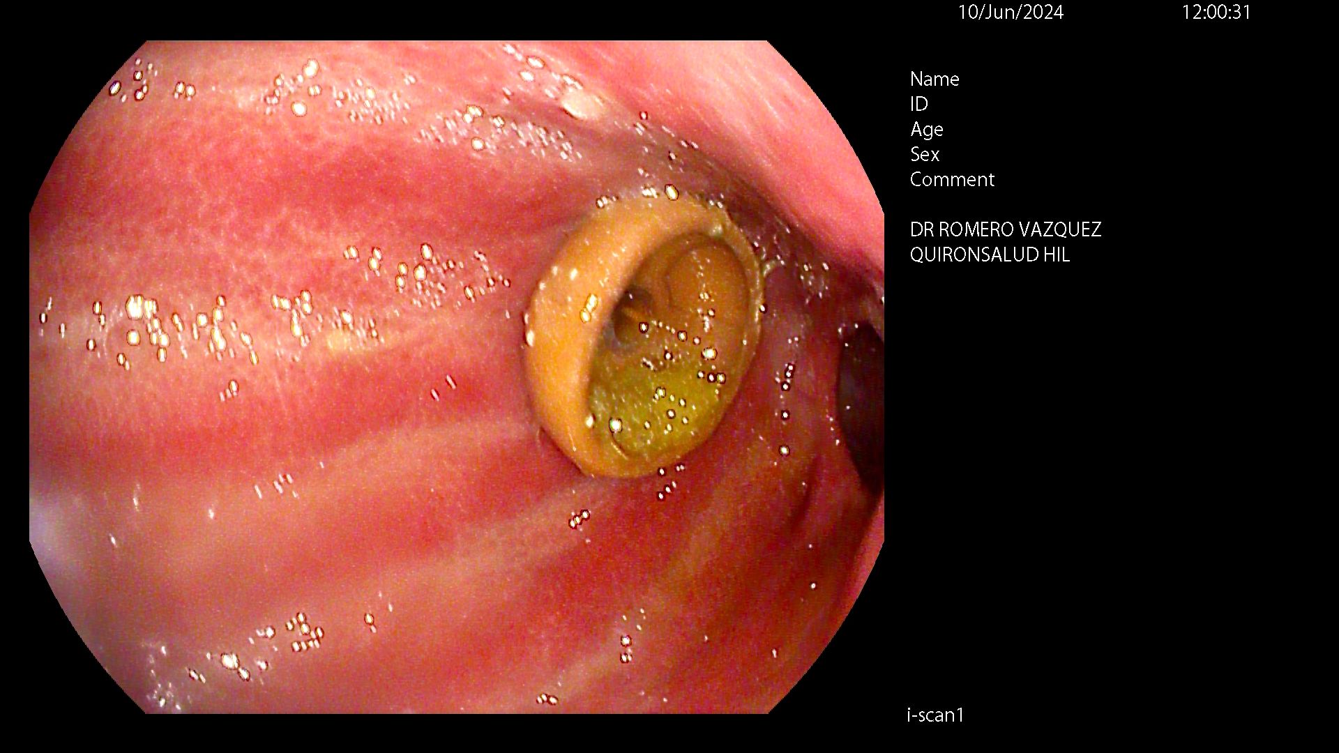 Recambio de sonda PEG - Paso 1