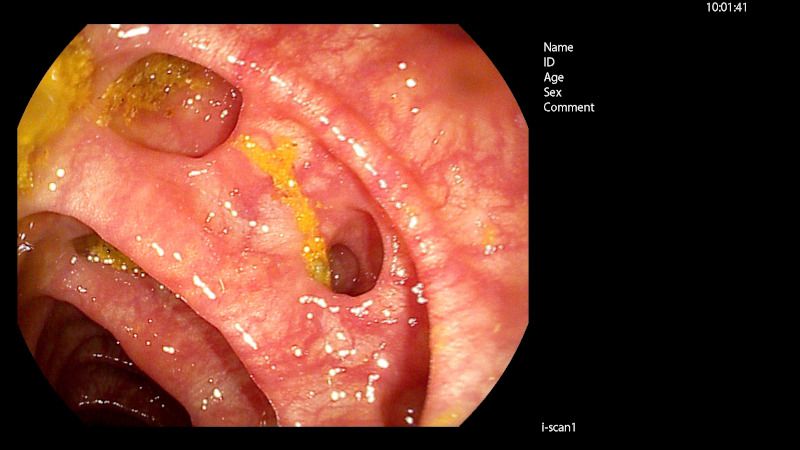 Diverticulosis de sigma