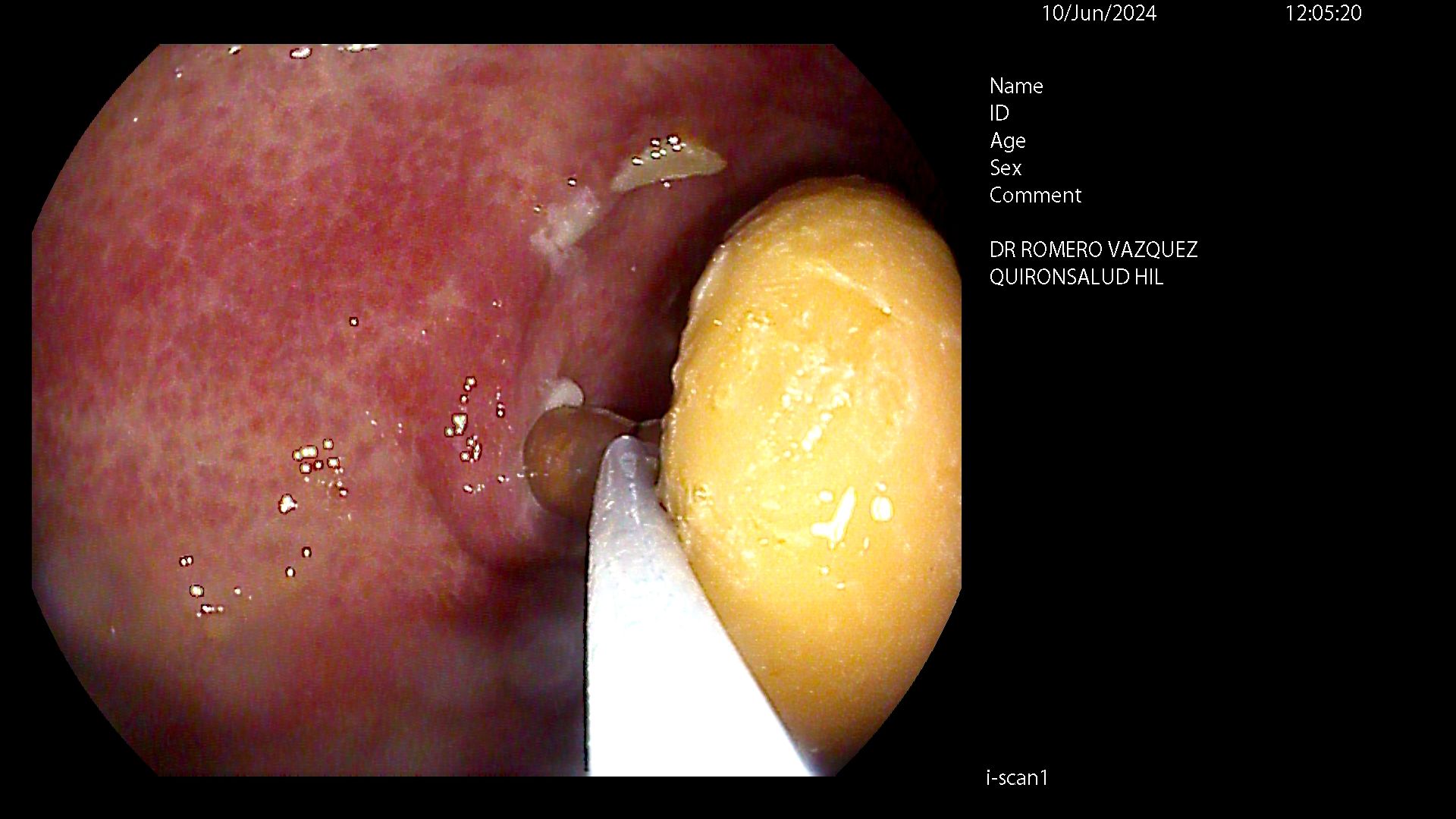 Recambio de sonda PEG - Paso 2