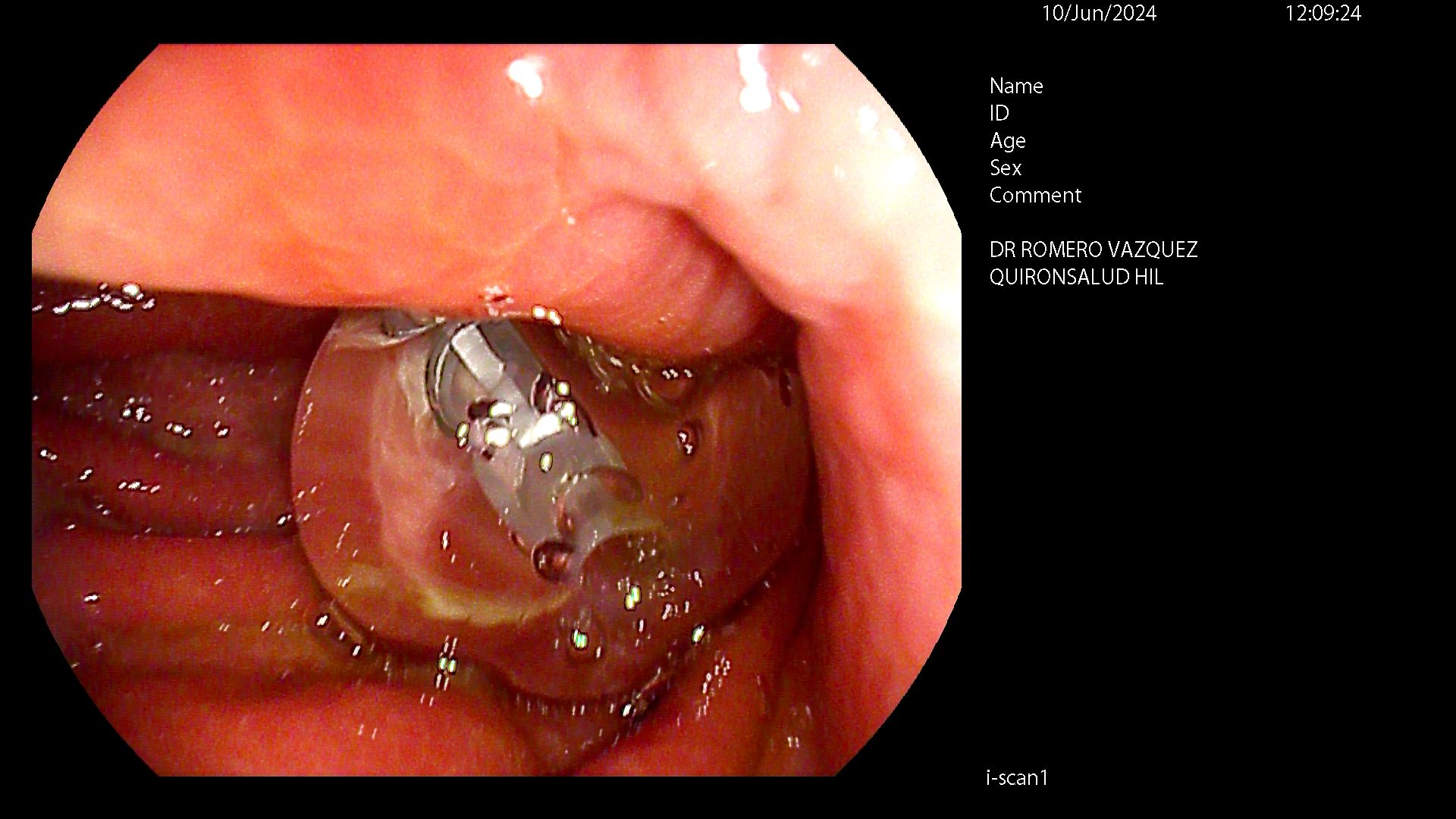 Recambio de sonda PEG - Paso 3