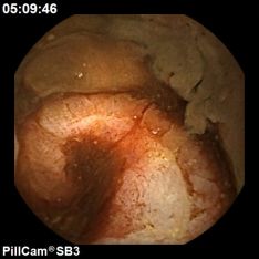 Cápsula endoscópica - Neoplasia