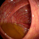 Imagen interna del intestino grueso durante colonoscopia