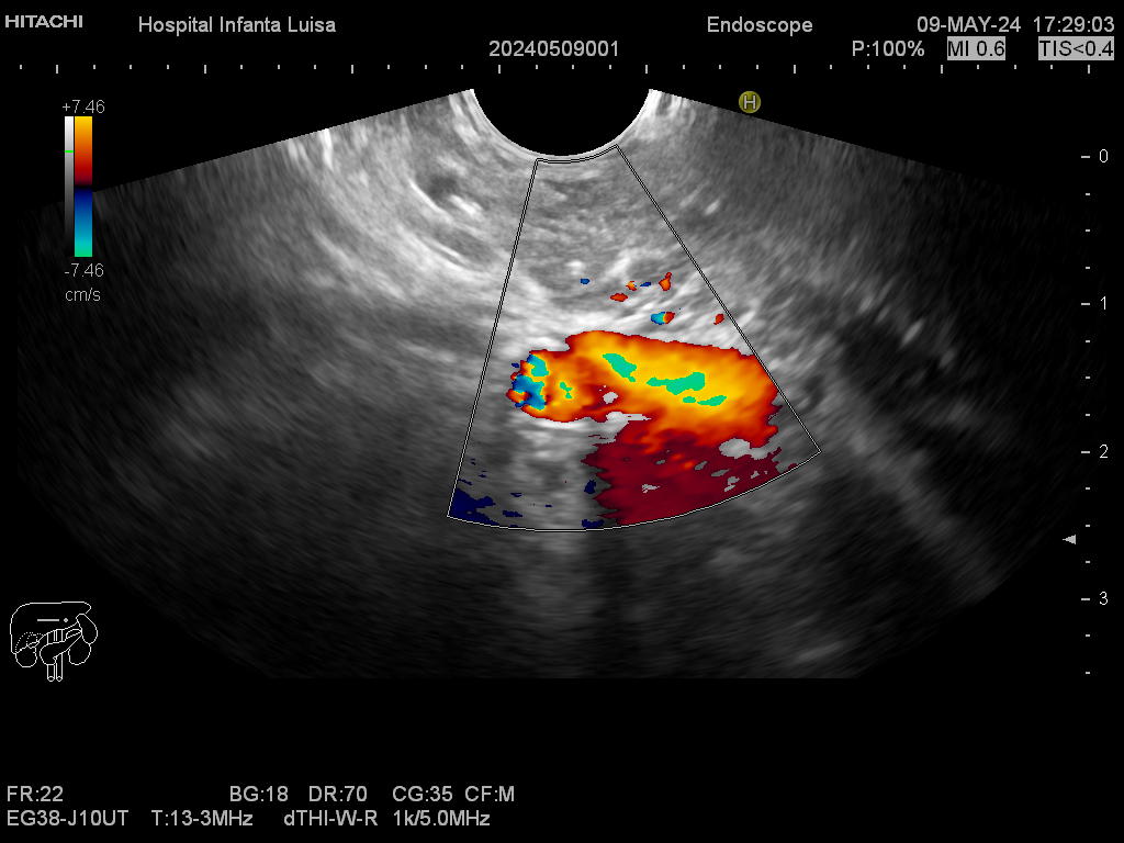 Cuerpo páncreas normal