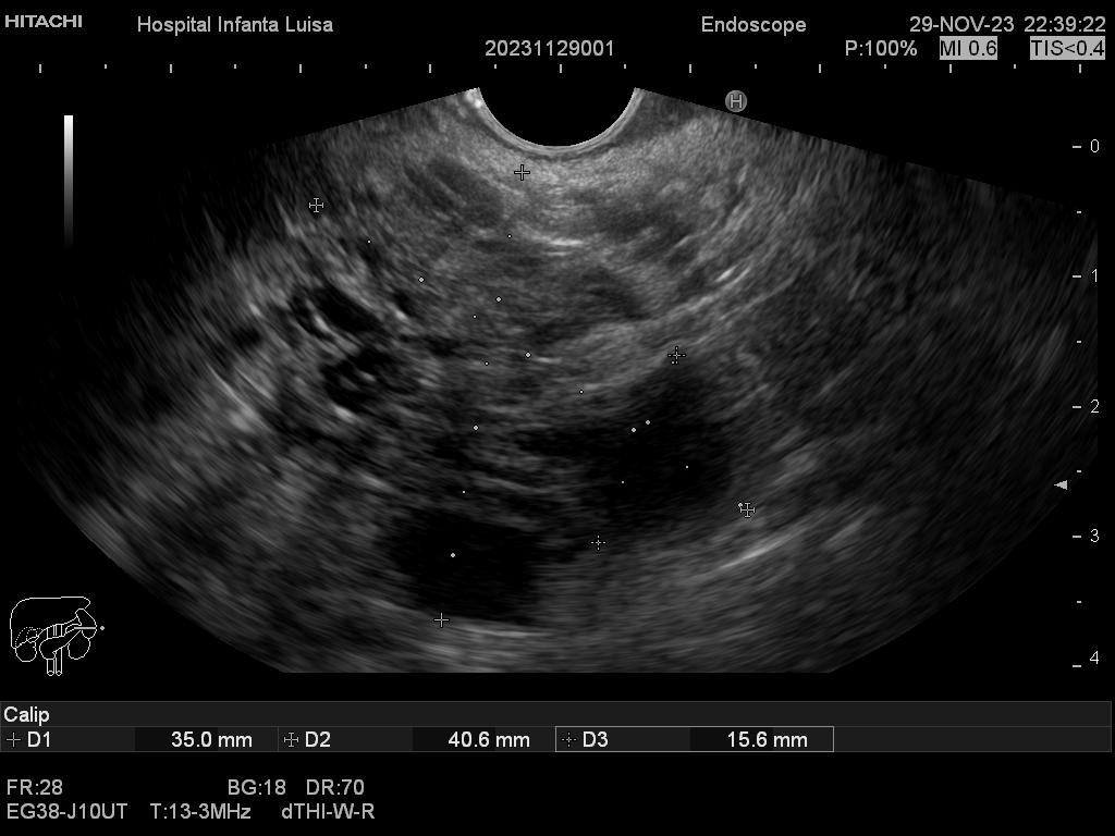 Formación quística de cabeza pancrática
