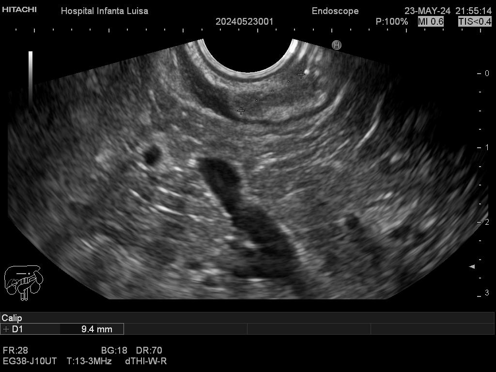 Formación subepitelial gástrica