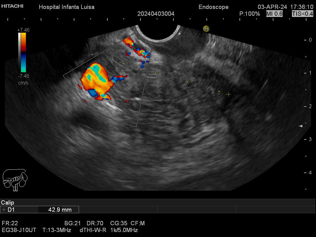 Masa de cabeza pancreática