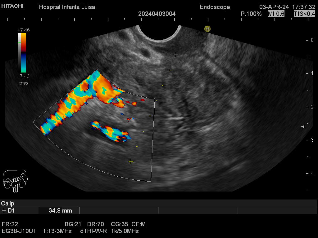Masa de cabeza pancreática con infiltración vascular