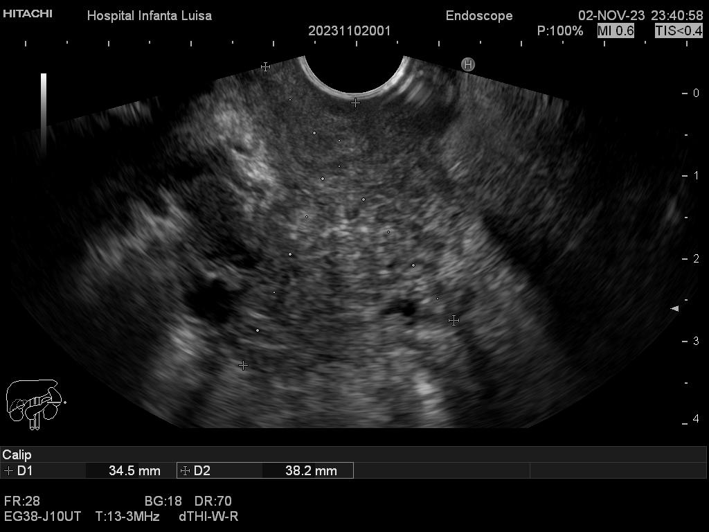 Masa de cabeza pancreática