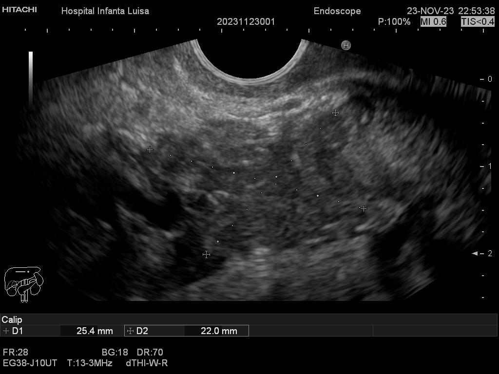 Masa de cabeza-cuello pancreático