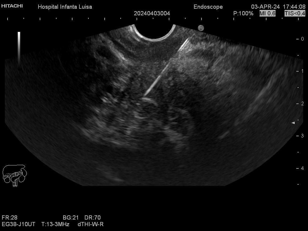 Punción lesión pancreática