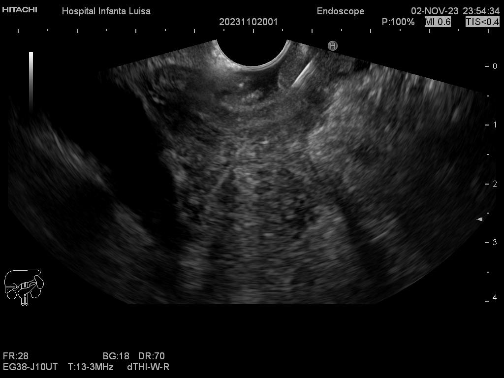 Punción o PAAF de masa pancreática