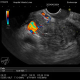 Imagen de la pantalla de un ecoendoscopio