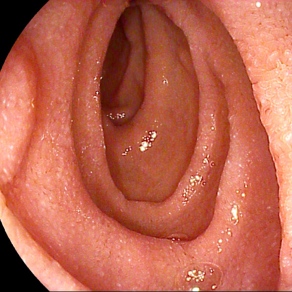 Segunda porción duodenal con patrón vellositario normal