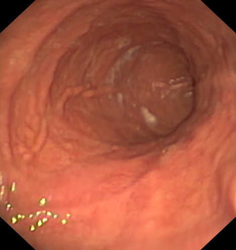 Apollo - Estómago antes de la intervención - 1