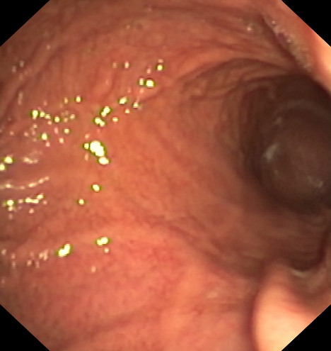 Apollo - Estómago antes de la intervención - 2