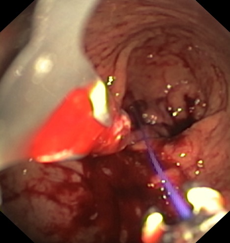 Apollo - Estómago durante la intervención - 2