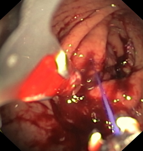 Apollo - Estómago durante la intervención - 3