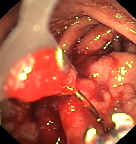 Apollo - Estómago durante la intervención - 4