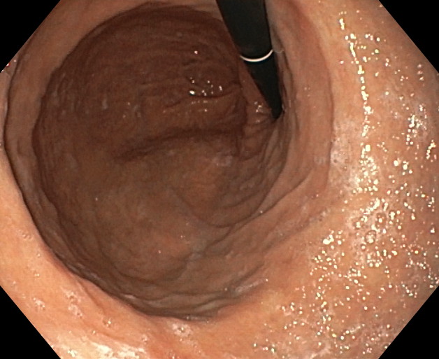 Endomanga - Estómago previo a cirugía. Visión desde antro-retroversión