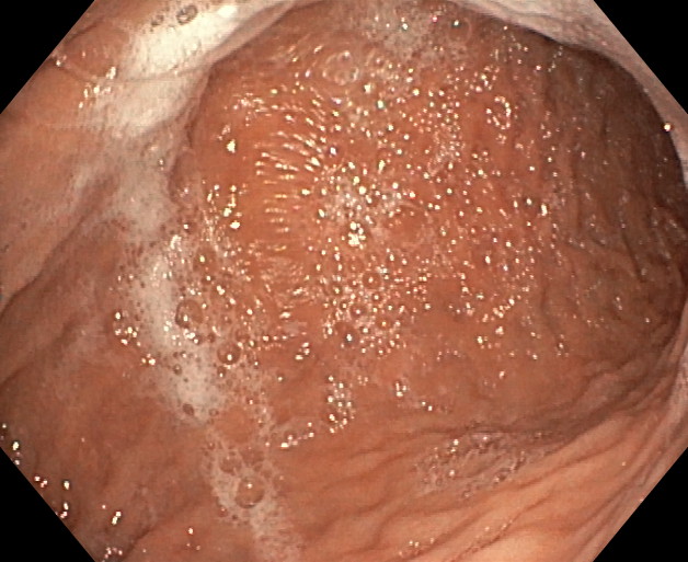 Endomanga - Estómago previo a cirugía. Visión desde esófago