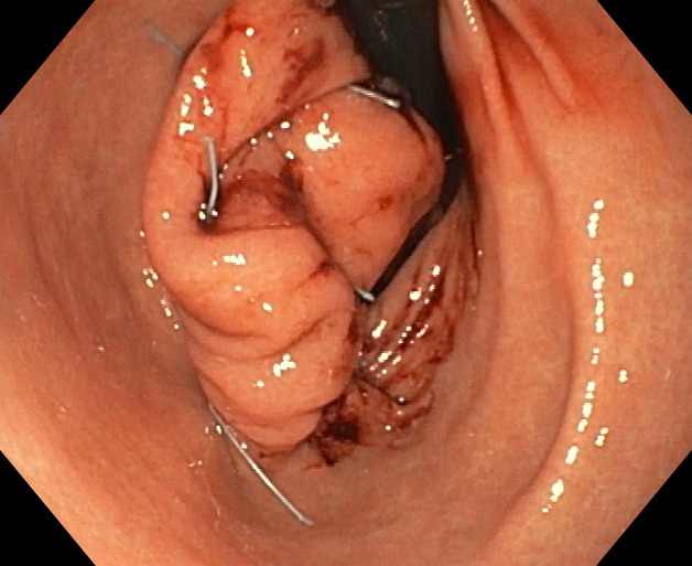 Endomanga - Estómago trasa cirugía. Visión desde antro-retroversión