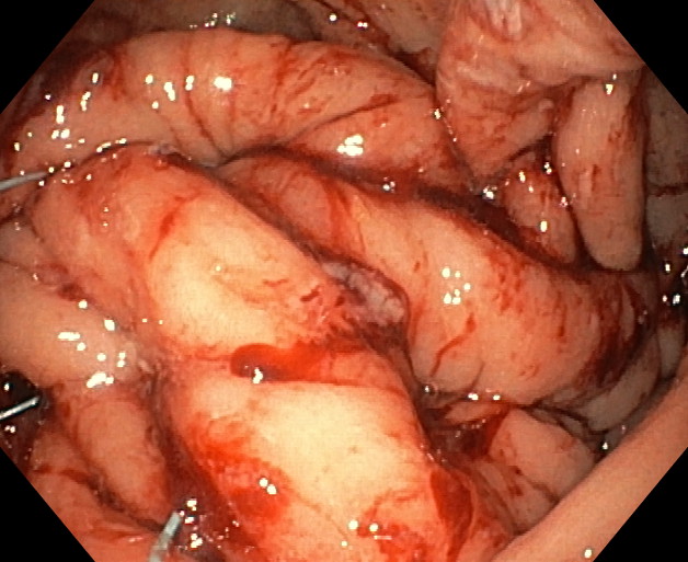 Endomanga - Estómago tras cirugía. Visión desde esófago