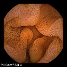 Cápsula endoscópica - Normal